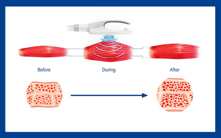 Effect On Muscle
