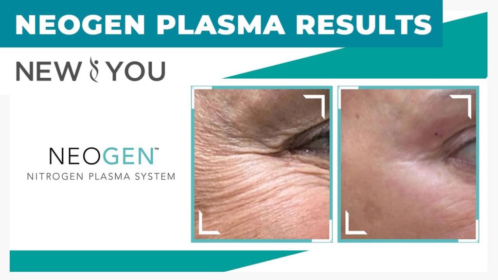 NeoGenPlasmaResults