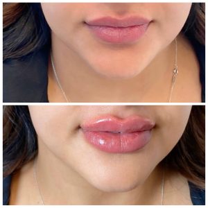 The Questions People Are Asking About Russian Doll Lips - New You Spa