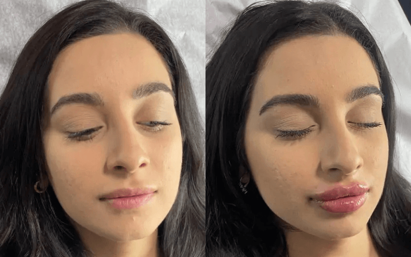 expert lip fillers in richmond hill