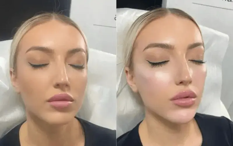 Dermal filler treatment at New You Cosmetic Centres Yorkville