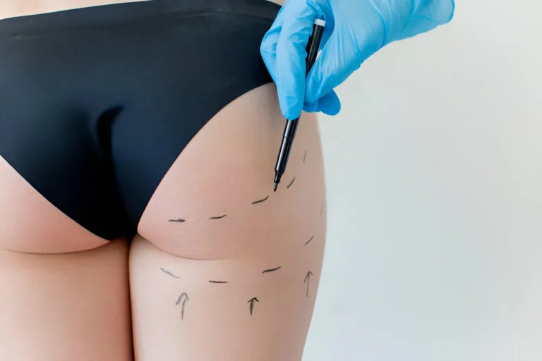 Non-Surgical Butt Lift vs Traditional BBL