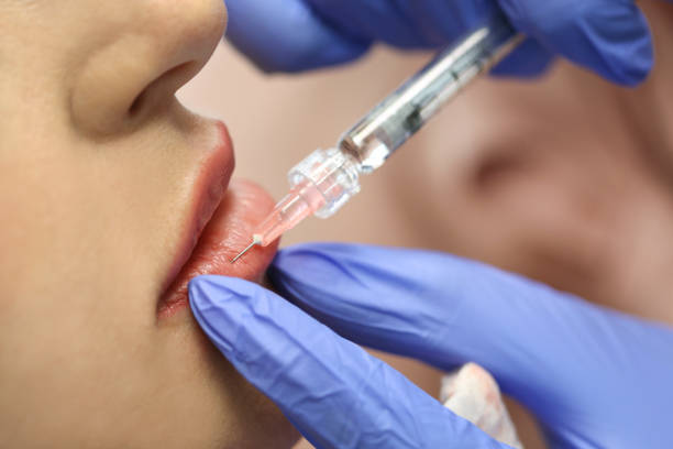 Lip Filler