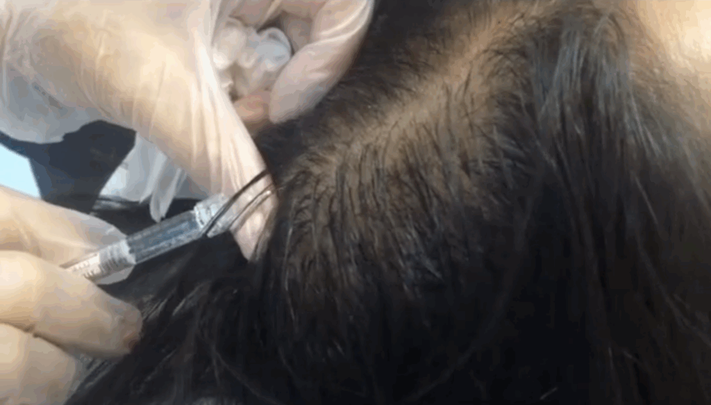 Benefits of Hair Restoration