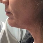 Non-Surgical Facelift Before & After Patient #9970