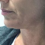 Non-Surgical Facelift Before & After Patient #9971