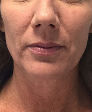 Non-Surgical Facelift Before & After Patient #9969
