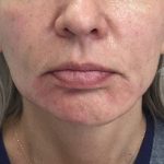 Non-Surgical Facelift Before & After Patient #9972