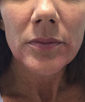 Non-Surgical Facelift Before & After Patient #9969