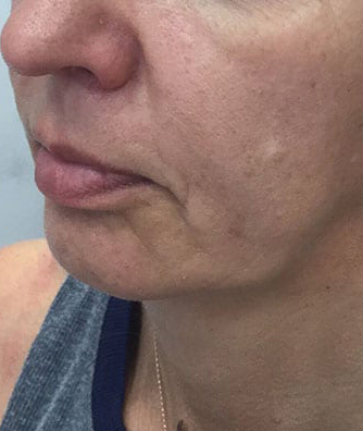 Non-Surgical Facelift Before & After Patient #9972