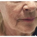 Non-Surgical Facelift Before & After Patient #9984