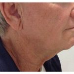 Non-Surgical Facelift Before & After Patient #9983