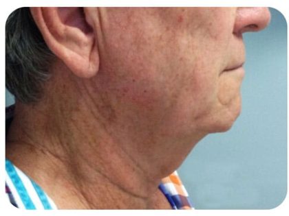 Non-Surgical Facelift Before & After Patient #9983