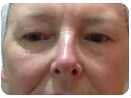 Microneedling Before & After Patient #9997