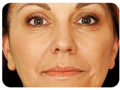 Microneedling Before & After Patient #9985