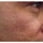 Microneedling Before & After Patient #9998