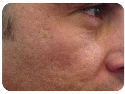 Microneedling Before & After Patient #9998