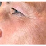 Microneedling Before & After Patient #9999