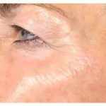 Microneedling Before & After Patient #9999