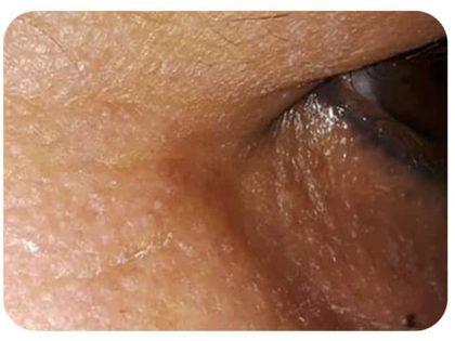 Microneedling Before & After Patient #10000