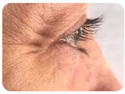 Microneedling Before & After Patient #9996