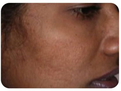 Microneedling Before & After Patient #10002
