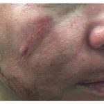 Microneedling Before & After Patient #10003