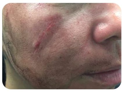 Microneedling Before & After Patient #10003