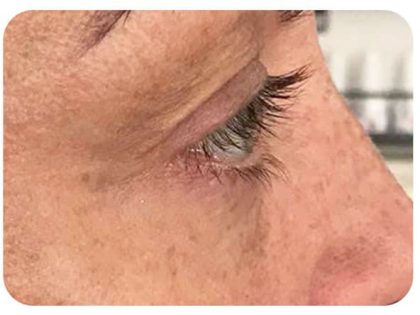 Microneedling Before & After Patient #9996