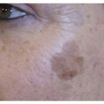 Pigmentation & Skin Tag Before & After Patient #10014