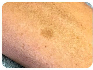 Pigmentation & Skin Tag Before & After Patient #10005