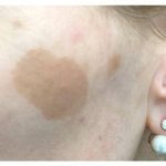 Pigmentation & Skin Tag Before & After Patient #10004