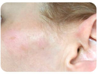 Pigmentation & Skin Tag Before & After Patient #10004
