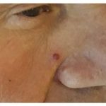Pigmentation & Skin Tag Before & After Patient #10013