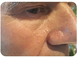 Pigmentation & Skin Tag Before & After Patient #10013
