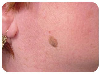 Pigmentation & Skin Tag Before & After Patient #10012