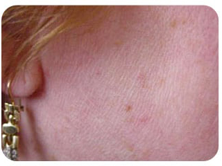 Pigmentation & Skin Tag Before & After Patient #10012