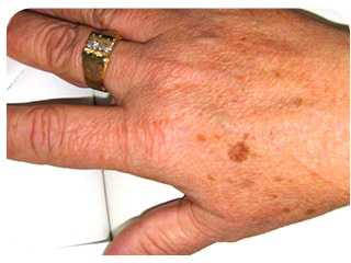 Pigmentation & Skin Tag Before & After Patient #10011
