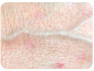 Pigmentation & Skin Tag Before & After Patient #10009