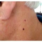 Pigmentation & Skin Tag Before & After Patient #10008