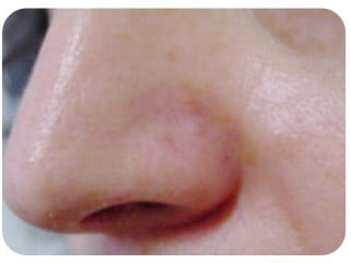 Pigmentation & Skin Tag Before & After Patient #10007