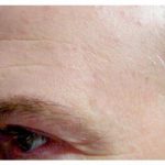 Pigmentation & Skin Tag Before & After Patient #10006