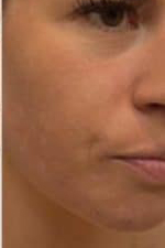 Skin Boosters Before & After Patient #9994