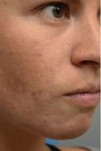 Skin Boosters Before & After Patient #9994