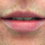 Lip Enhancement Before & After Patient #11325
