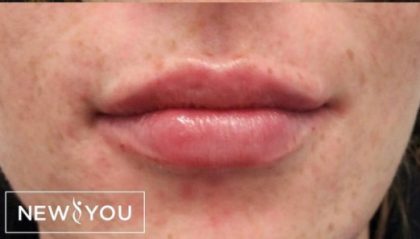 Lip Enhancement Before & After Patient #11325