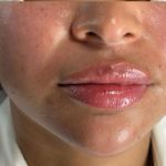 Lip Enhancement Before & After Patient #11326