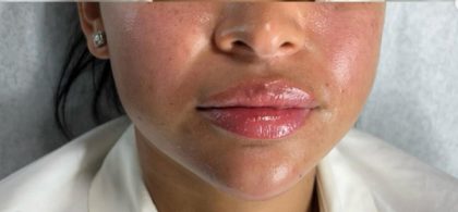 Lip Enhancement Before & After Patient #11326