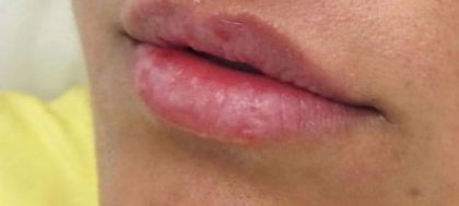 Lip Enhancement Before & After Patient #11327