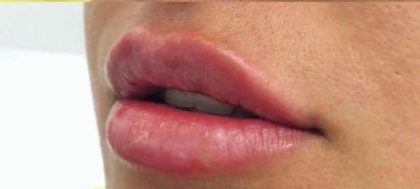 Lip Enhancement Before & After Patient #11327